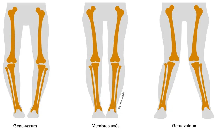 La Prise en Charge des Douleurs de Genoux(Gonalgie) par Semelles Orthopédiques : La Solution Biomécanique 2/2